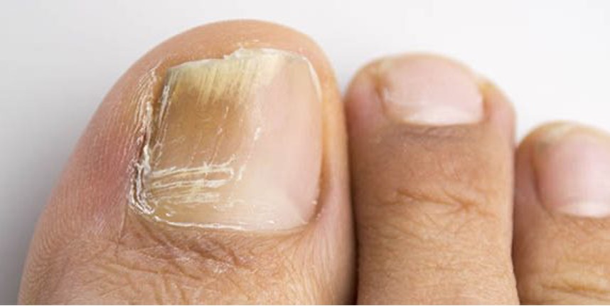 Fungal nail picture